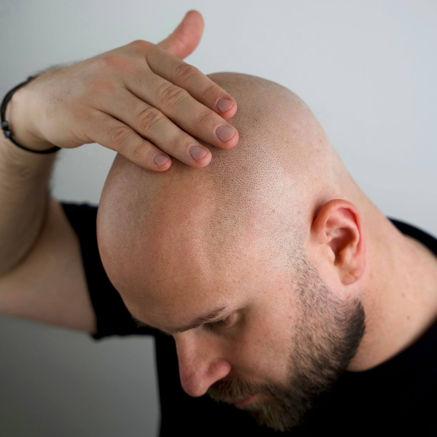 Bald Peeling, 150 ml.